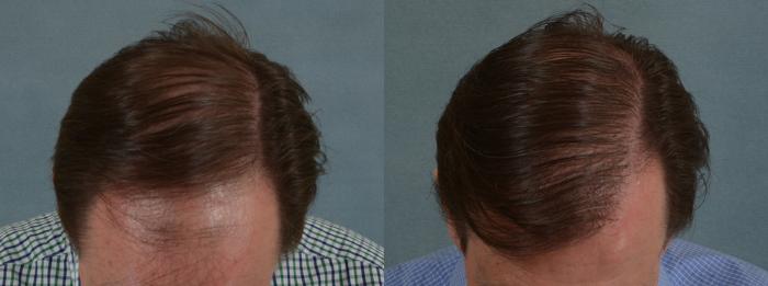 Before & After Hair Restoration Case 57 View #2 View in Tallahassee, FL