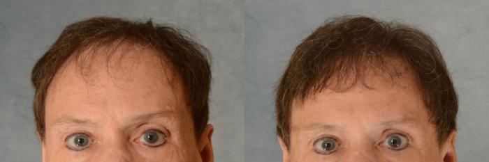 Before & After Hair Restoration Case 570 Front View in Tallahassee, FL