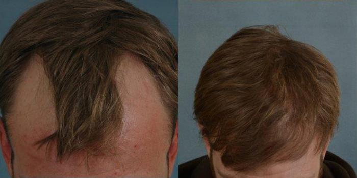 Before & After Hair Restoration Case 58 View #1 View in Tallahassee, FL