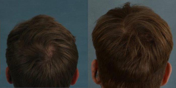 Before & After Hair Restoration Case 58 View #2 View in Tallahassee, FL
