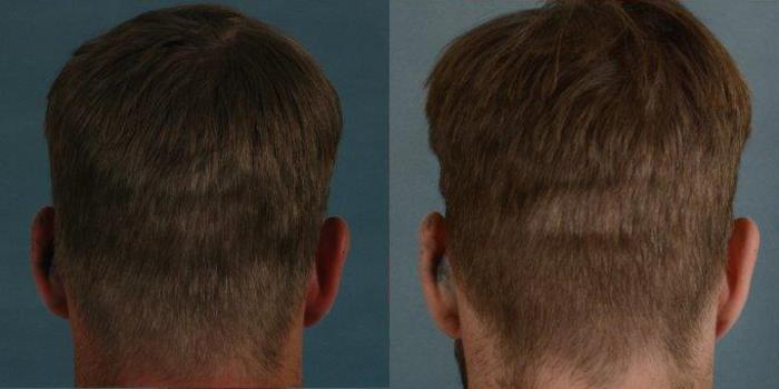 Before & After Hair Restoration Case 58 View #3 View in Tallahassee, FL