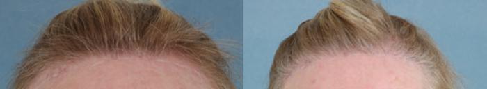 Before & After Hair Restoration Case 59 View #1 View in Tallahassee, FL
