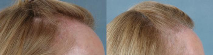 Before & After Hair Restoration Case 59 View #2 View in Tallahassee, FL