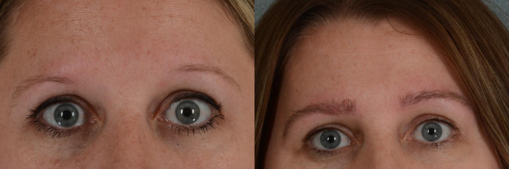 Hair Transplant (Eyebrows) Before and After Photo Gallery | Tallahassee, FL  | Southeastern Plastic Surgery, .