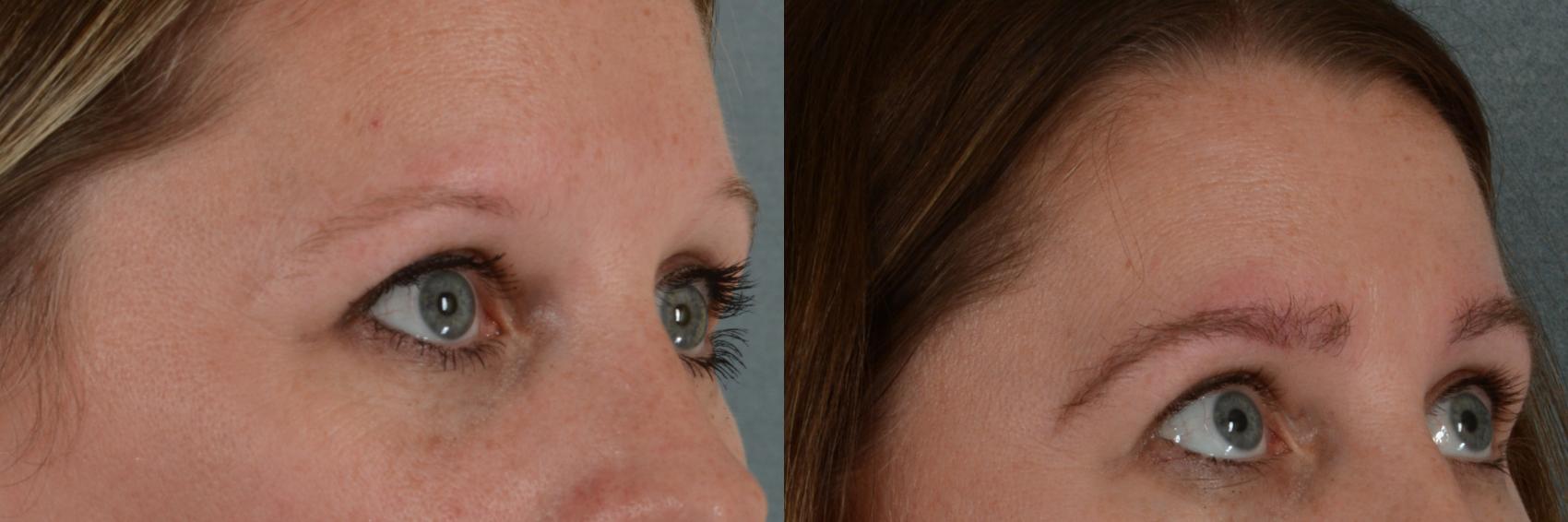 Hair Transplant (Eyebrows) Before and After Pictures Case 302