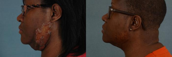 Before & After Keloid Reconstruction Case 254 View #2 View in Tallahassee, FL