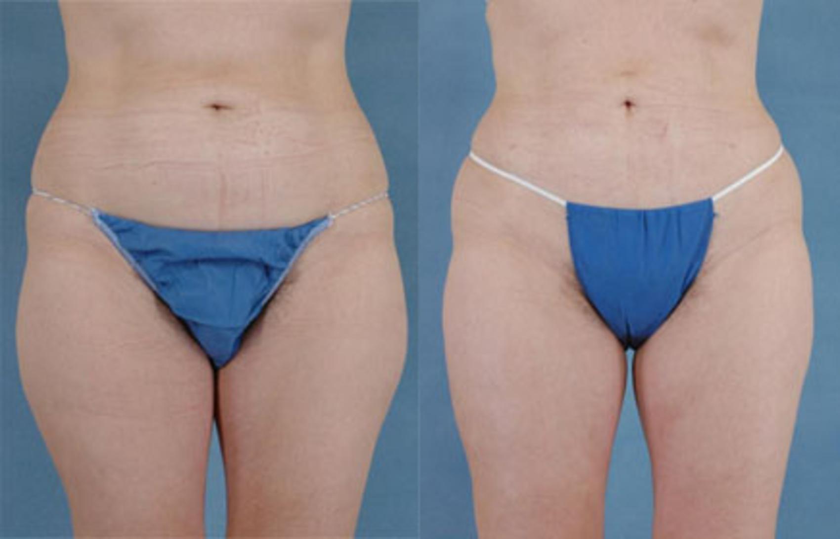 Before & After Liposuction Case 109 View #1 View in Tallahassee, FL