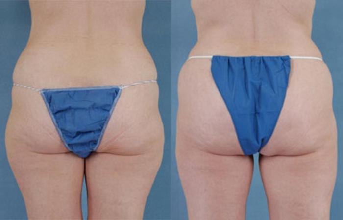 Before & After Liposuction Case 109 View #3 View in Tallahassee, FL