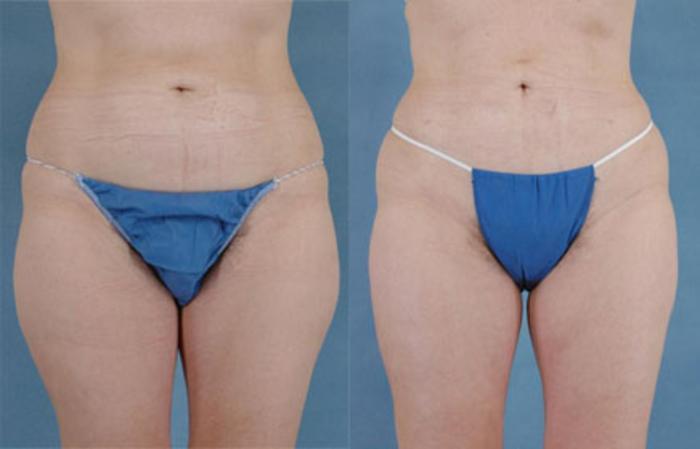 Before & After Liposuction Case 110 View #1 View in Tallahassee, FL