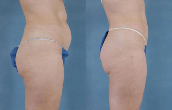 Before & After Liposuction Case 110 View #2 View in Tallahassee, FL