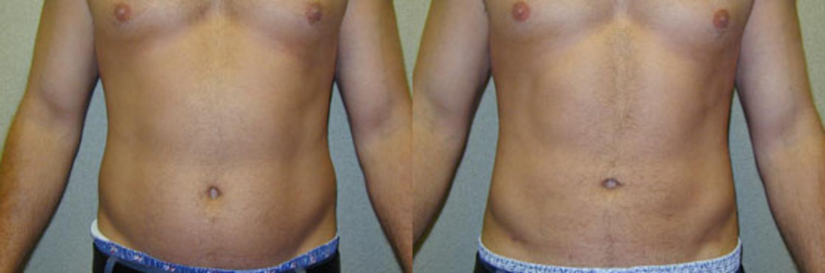 Before & After Liposuction Case 111 View #1 View in Tallahassee, FL