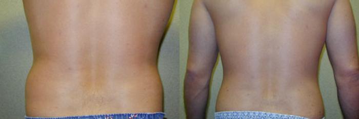 Before & After Liposuction Case 111 View #2 View in Tallahassee, FL