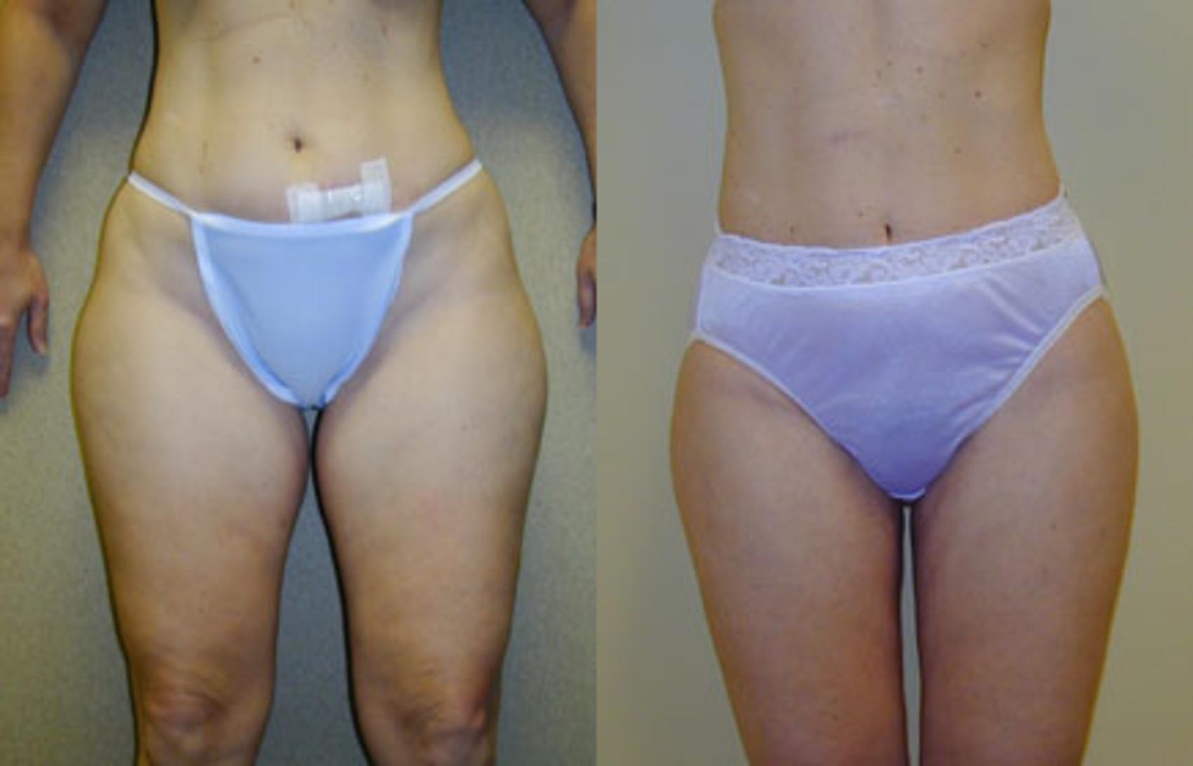 Before & After Liposuction Case 112 View #1 View in Tallahassee, FL
