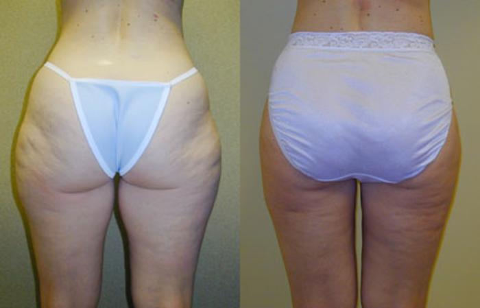 Before & After Liposuction Case 112 View #2 View in Tallahassee, FL