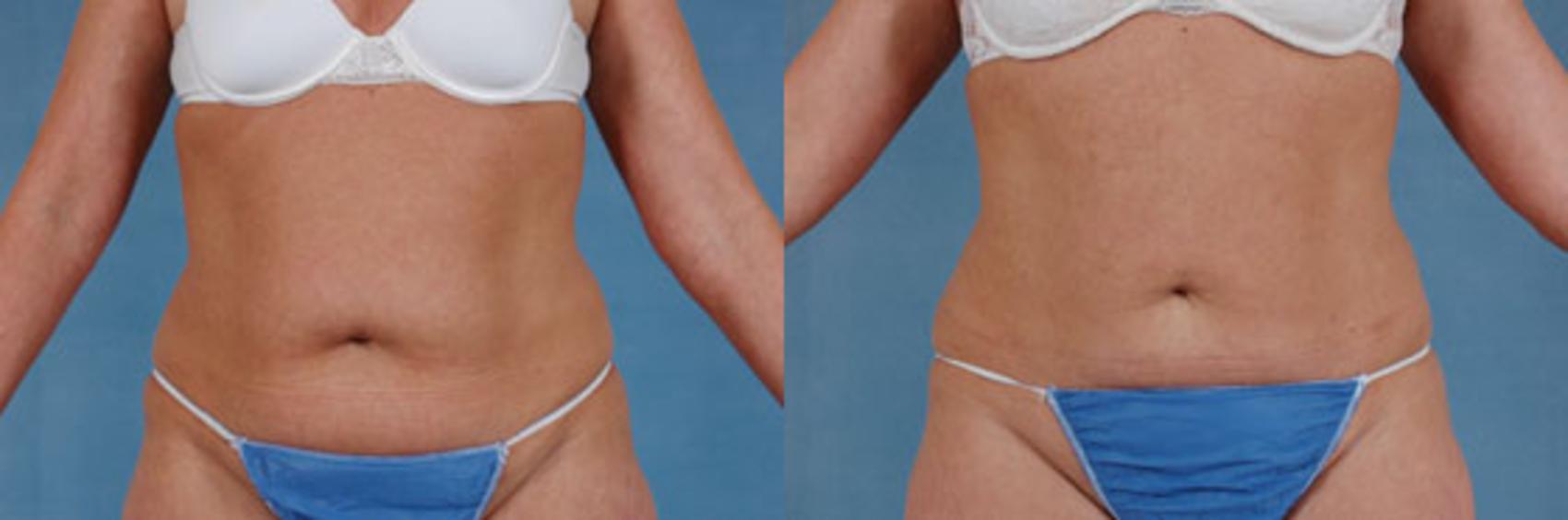Before & After Liposuction Case 113 View #1 View in Tallahassee, FL