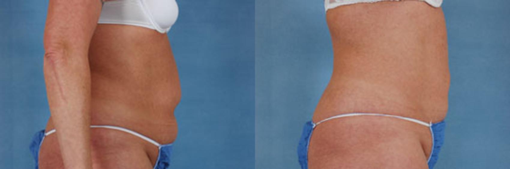 Before & After Liposuction Case 113 View #2 View in Tallahassee, FL