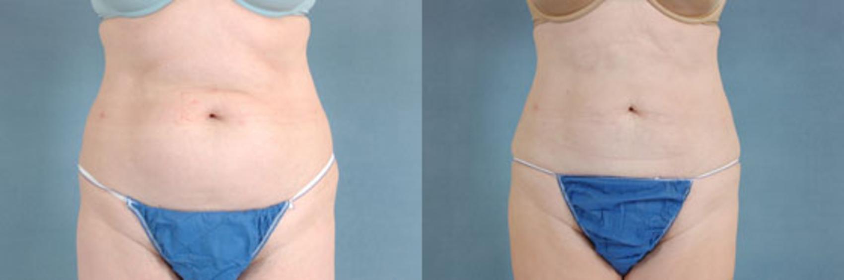 Before & After Liposuction Case 114 View #1 View in Tallahassee, FL