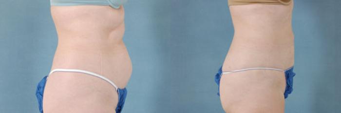 Before & After Liposuction Case 114 View #2 View in Tallahassee, FL
