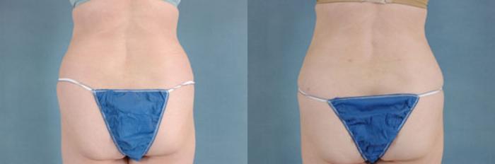 Before & After Liposuction Case 114 View #3 View in Tallahassee, FL