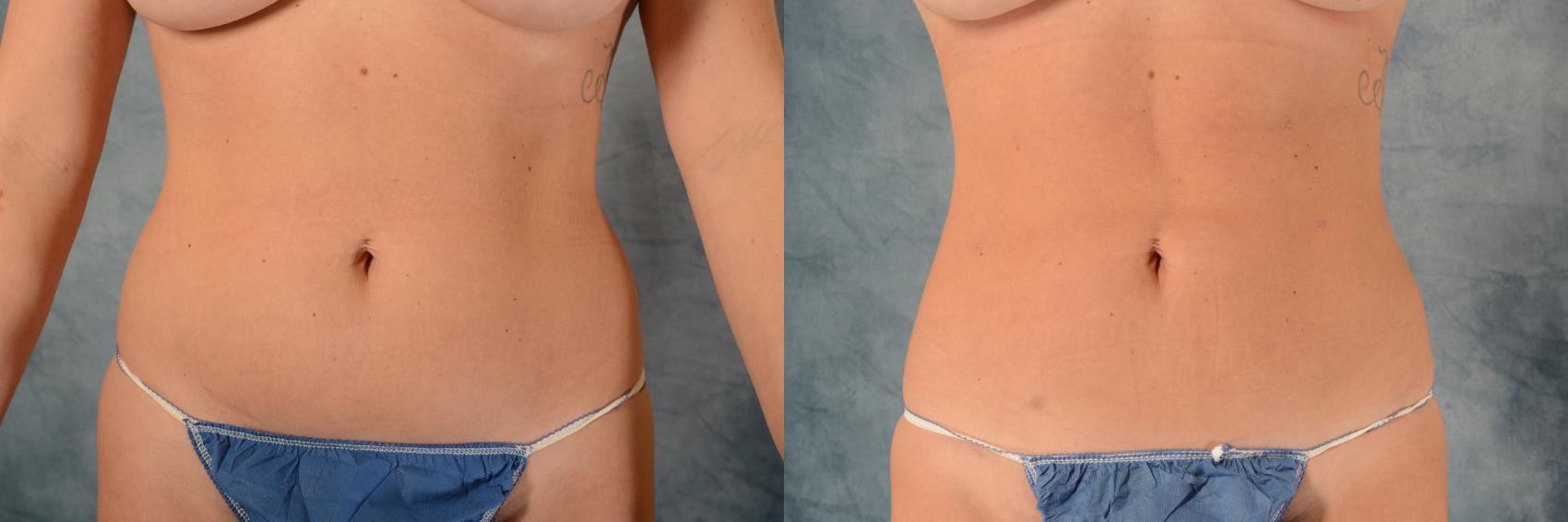 Before & After Liposuction Case 492 Front View in Tallahassee, FL