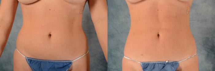 Before & After Liposuction Case 492 Front View in Tallahassee, FL