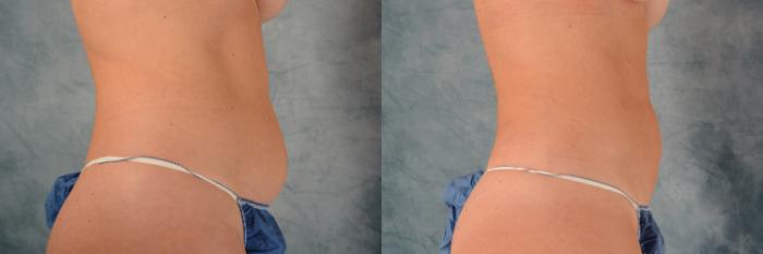 Before & After Liposuction Case 492 Right Side View in Tallahassee, FL