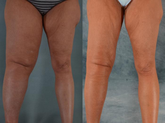 Before & After Liposuction Case 539 Front View in Tallahassee, FL