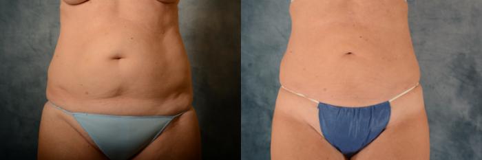 Before & After Liposuction Case 597 Front View in Tallahassee, FL