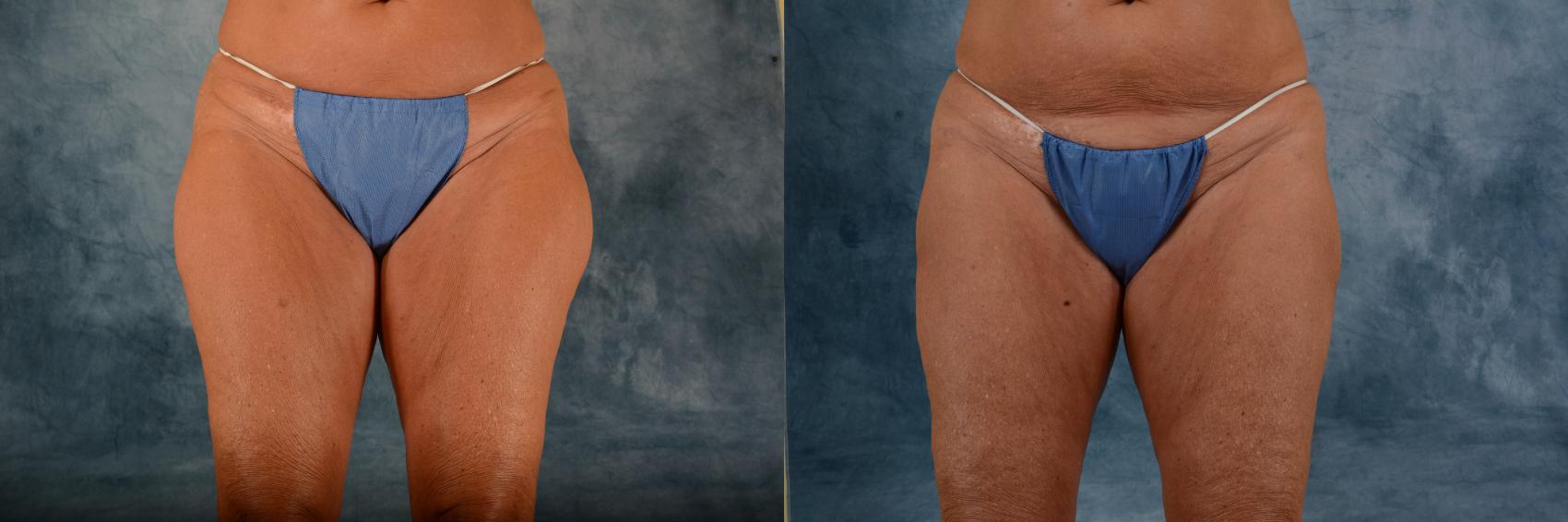 Before & After Liposuction Case 721 Front View in Tallahassee, FL
