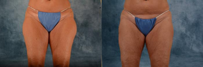 Before & After Liposuction Case 721 Front View in Tallahassee, FL