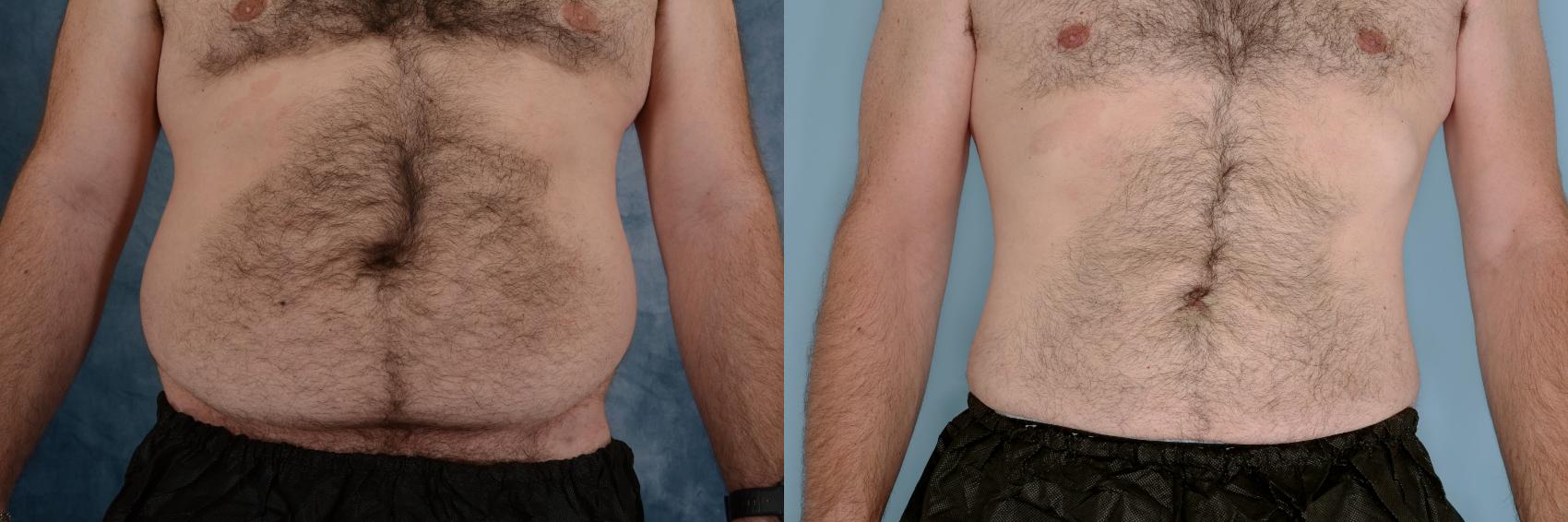 Before & After Liposuction Case 759 Front View in Tallahassee, FL