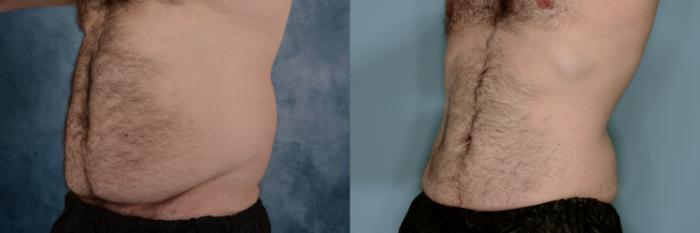 Before & After Liposuction Case 759 Left Oblique View in Tallahassee, FL