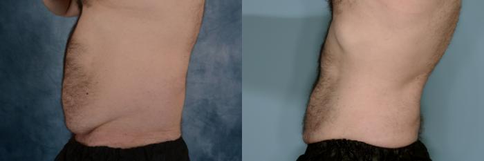Before & After Liposuction Case 759 Left Side View in Tallahassee, FL