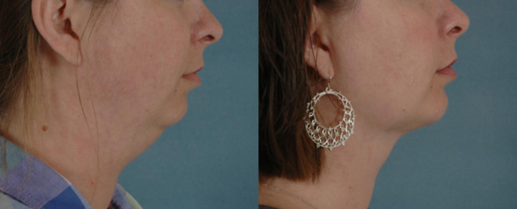 Before & After Liposuction of the Neck/Chin Case 240 View #1 View in Tallahassee, FL