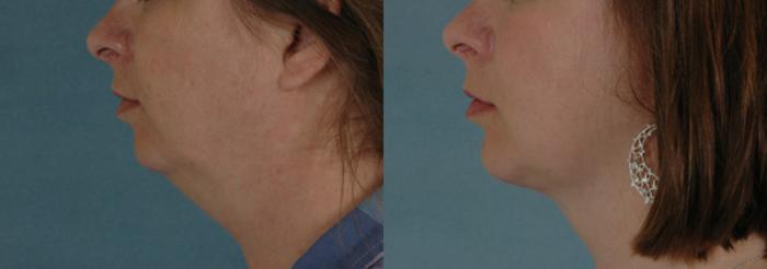 Before & After Liposuction of the Neck/Chin Case 240 View #2 View in Tallahassee, FL