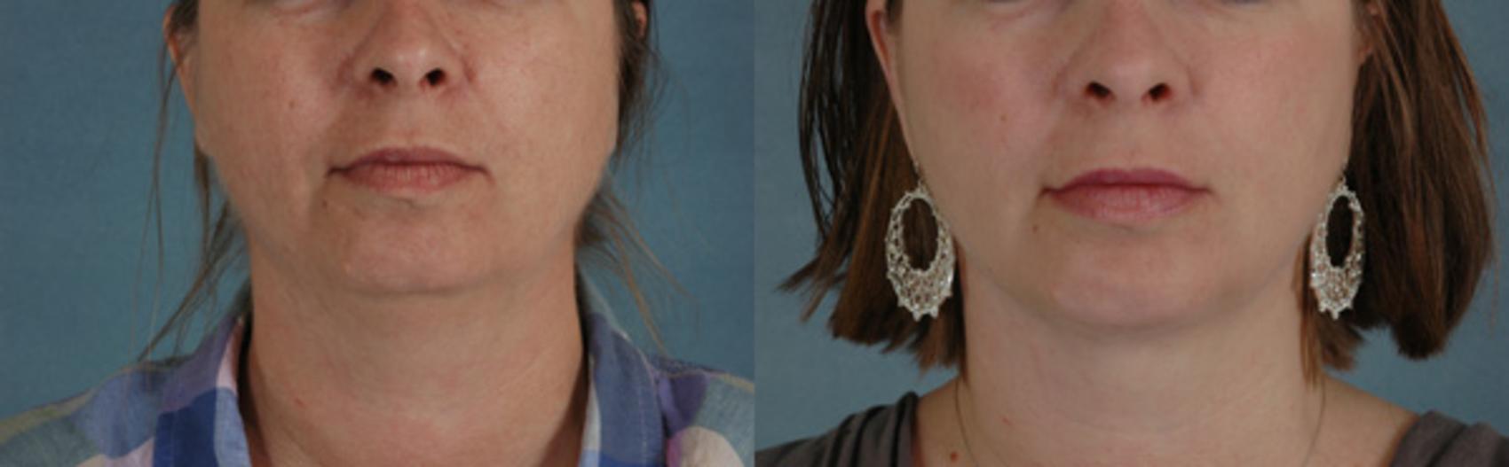 Liposuction of the Neck/Chin Before and After Pictures Case 240