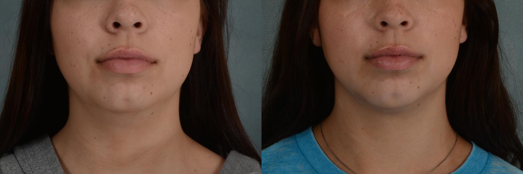 Before & After Liposuction of the Neck/Chin Case 349 View #1 View in Tallahassee, FL
