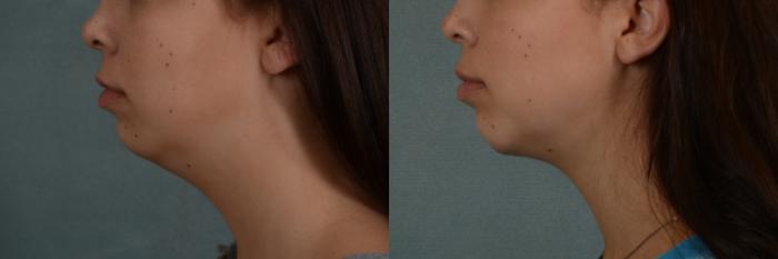 Before & After Liposuction of the Neck/Chin Case 349 View #2 View in Tallahassee, FL