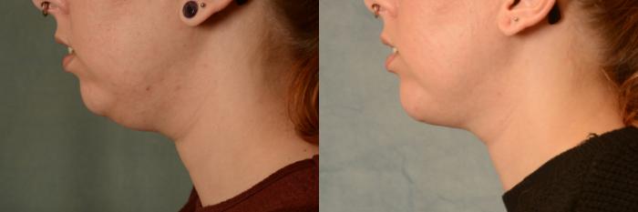 Before & After Liposuction of the Neck/Chin Case 472 Left Side View in Tallahassee, FL