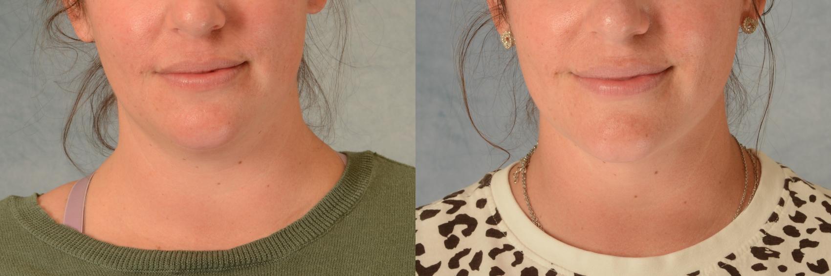 Before & After Liposuction of the Neck/Chin Case 476 Front View in Tallahassee, FL