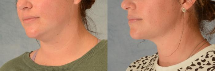 Before & After Liposuction of the Neck/Chin Case 476 Left Oblique View in Tallahassee, FL