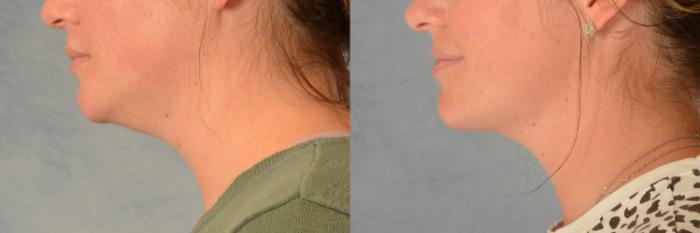 Before & After Liposuction of the Neck/Chin Case 476 Left Side View in Tallahassee, FL