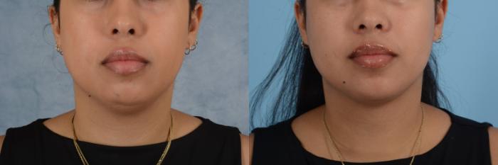 Before & After Liposuction of the Neck/Chin Case 654 Front View in Tallahassee, FL