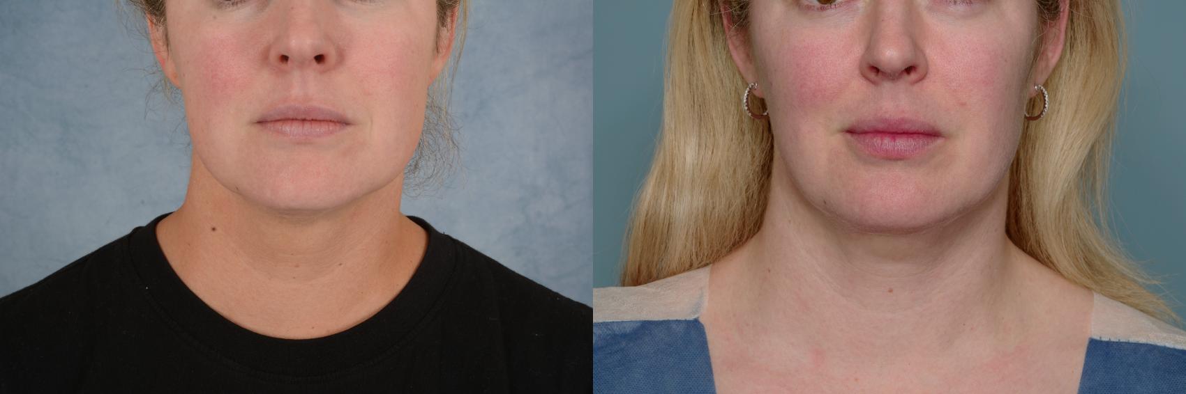 Before & After Liposuction of the Neck/Chin Case 674 Front View in Tallahassee, FL