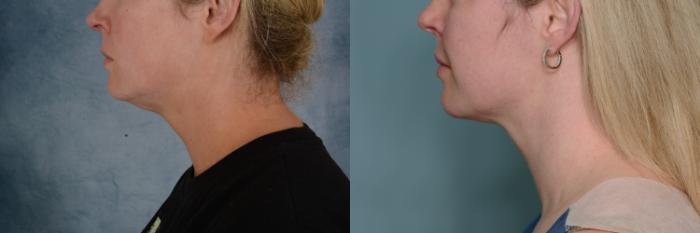 Before & After Liposuction of the Neck/Chin Case 674 Left Side View in Tallahassee, FL