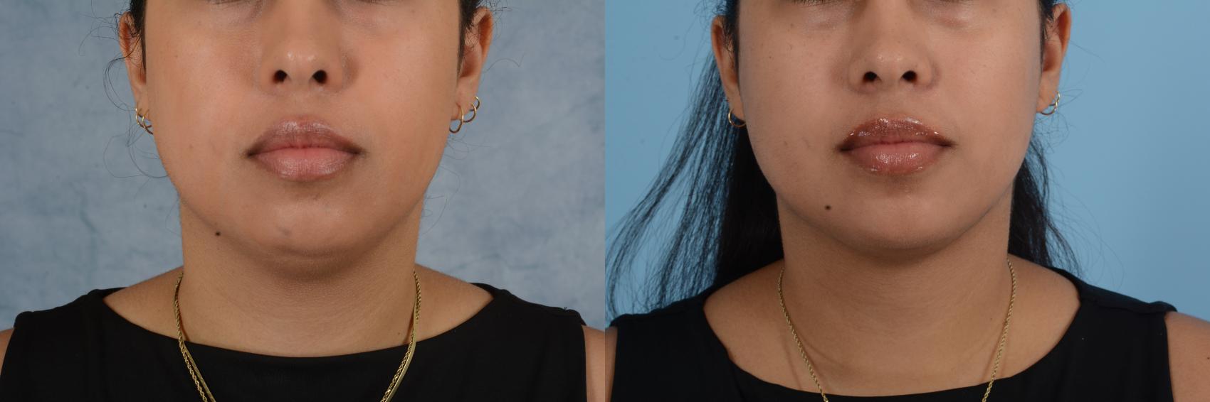 Before & After Liposuction of the Neck/Chin Case 691 Front View in Tallahassee, FL