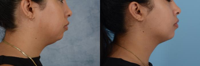 Before & After Liposuction of the Neck/Chin Case 691 Right Side View in Tallahassee, FL