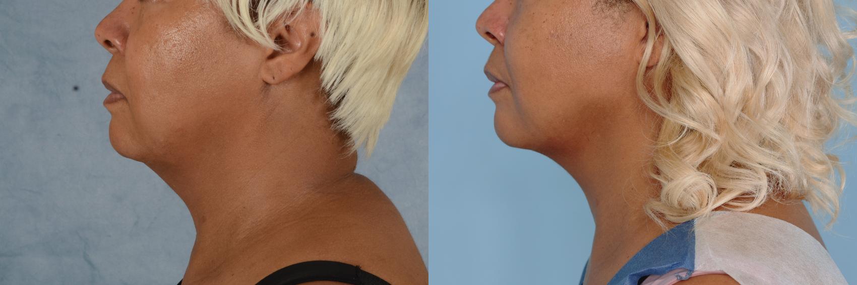 Before & After Liposuction of the Neck/Chin Case 702 Left Side View in Tallahassee, FL