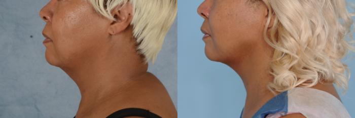 Before & After Liposuction of the Neck/Chin Case 702 Left Side View in Tallahassee, FL