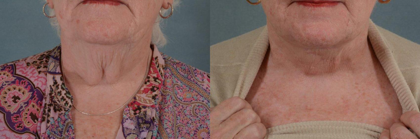 Before & After Neck Lift Case 241 View #1 View in Tallahassee, FL